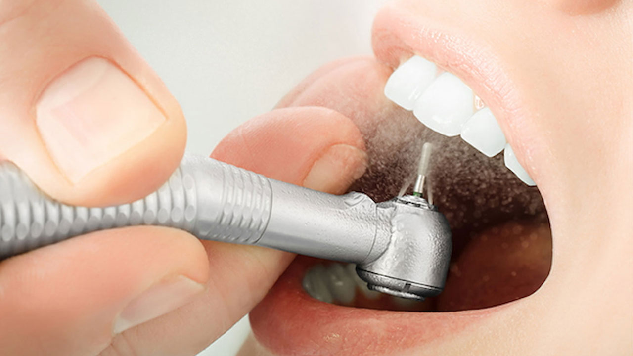 Bao lâu nên lấy cao răng một lần?