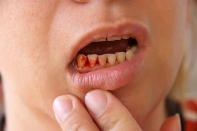 Kiểm tra nếu nướu chảy máu