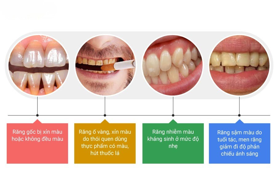Những trường hợp nên tẩy trắng răng, để đảm bảo thẩm mỹ khuôn mặt