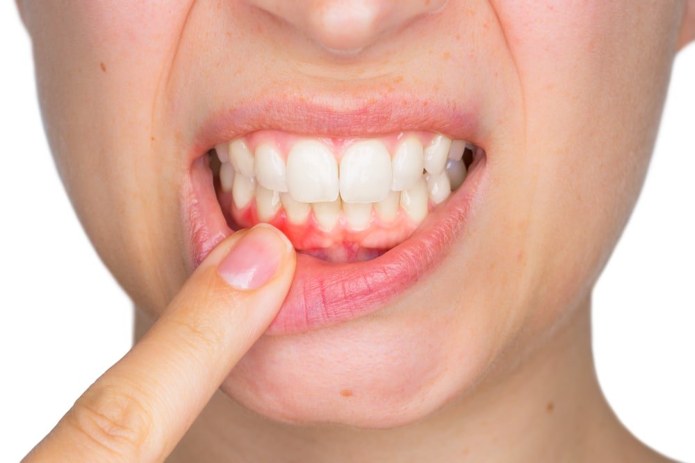 Dấu Hiệu Nào Cho Thấy Bạn Có Thể Đang Bị Bệnh Nha Chu?